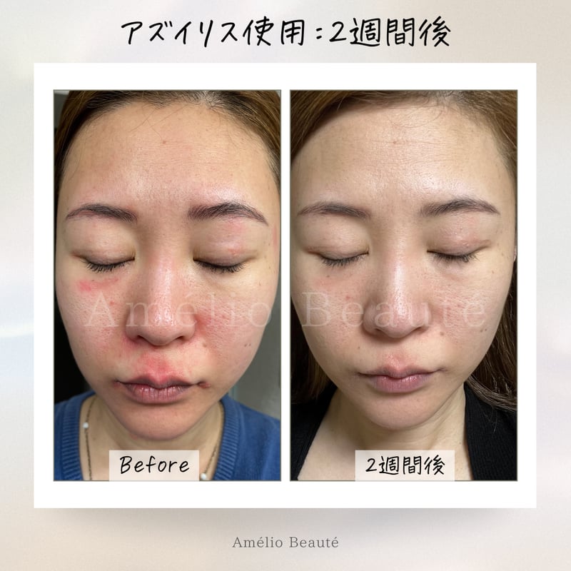 アズイリス 【As_iris】 炭酸ガスペーストパック 経皮吸収剤